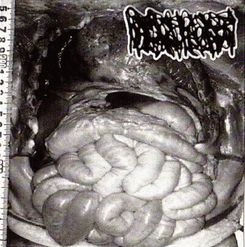 Hydrocephalus : The Science of Forensic Death Versus the Basic Mechanics of Medico-Legal Pathological Jurisprudence